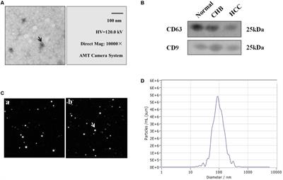 Extracellular Vesicle-Associated mir-21 and mir-144 Are Markedly Elevated in Serum of Patients With Hepatocellular Carcinoma